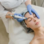 microneedling pics 150x150